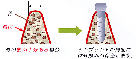 骨の幅が十分ある場合