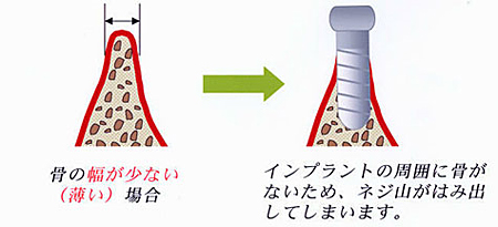 骨の幅が少ない（薄い）場合