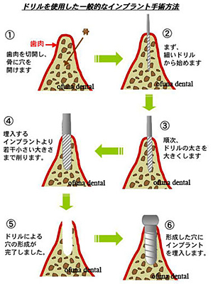 ドリルを使用しないで、骨を押し広げる『スプリッティング法』とは