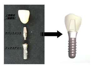 インプラントの構造