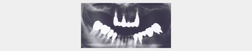 顎臼歯部に骨の高さがまったくない場合