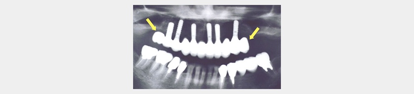 顎臼歯部に骨の高さがまったくない場合