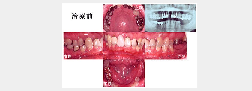 奥歯が2歯欠損しているケース