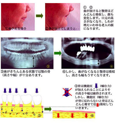 歯がないと顎の骨はどんどんと痩せてしまいます