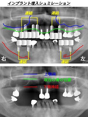 インプラント埋入シュミレーション