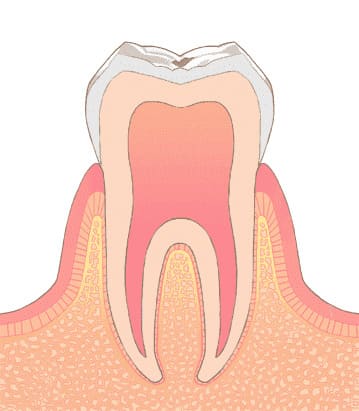 C0 歯を削らなくてすむごく初期のむし歯