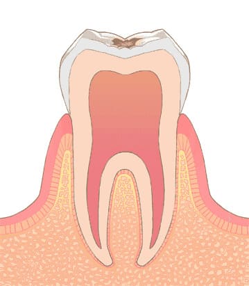 C1 歯の表面の虫歯（エナメル質への影響）