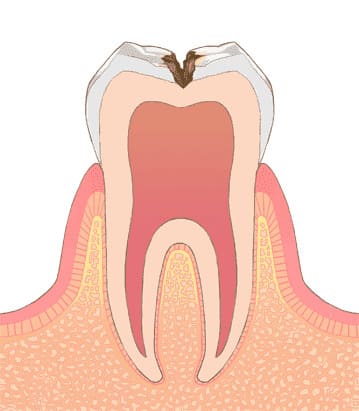 C2 象牙質まで進行した虫歯