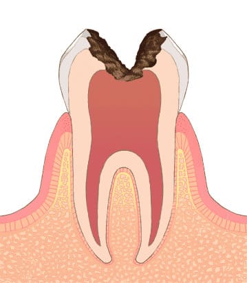 C3 神経に達する虫歯（歯髄の侵襲）
