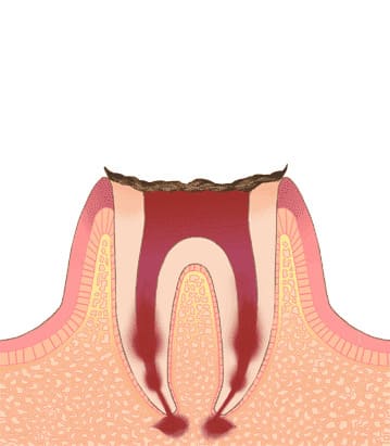 C4 末期の虫歯