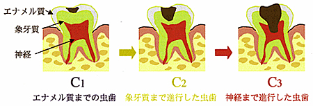 虫歯のレベル