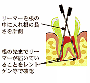 歯の根の長さを測定