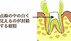 樹脂を入れ根管を封鎖