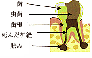 神経を取った後に治療が中断してしまった時