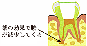 膿やバイ菌の除去が終了したら