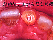 治療後上から見た状態