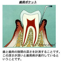 飲み薬で歯周病を治す！   インプラントや歯周病治療は横浜・鎌倉