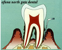 歯周病が進行すると『歯石』や『プラーク』は、『歯周ポケット内部』にどんどんと侵入してしまいます。