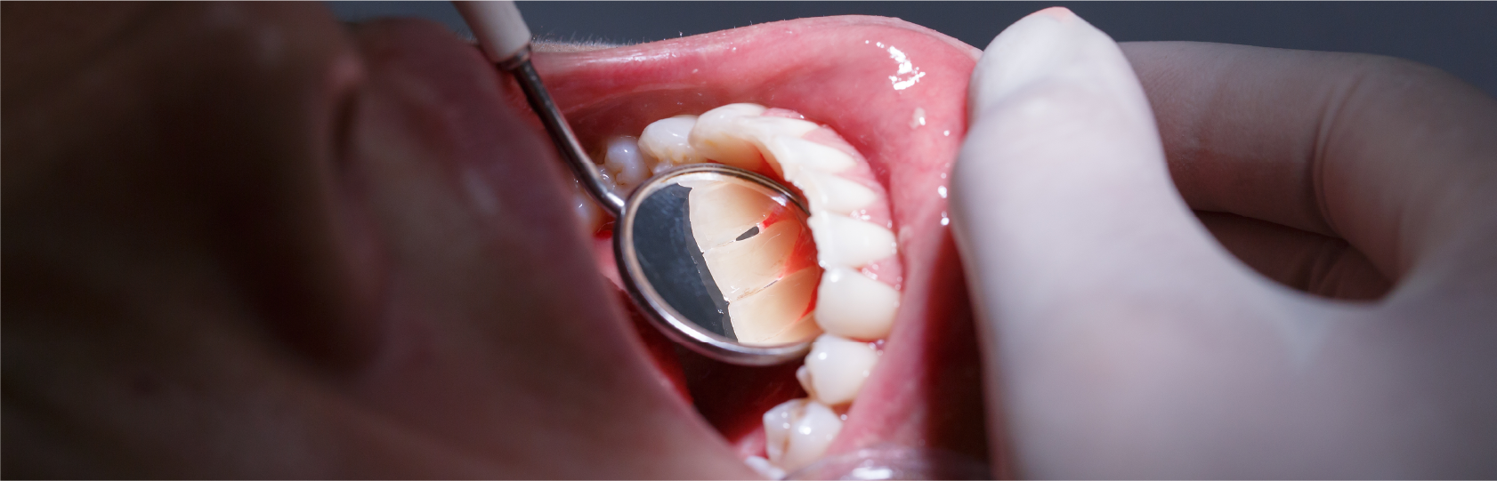 「歯周病」と診断されたらどうするべきか