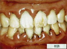 歯周病治療前