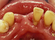歯周病治療前