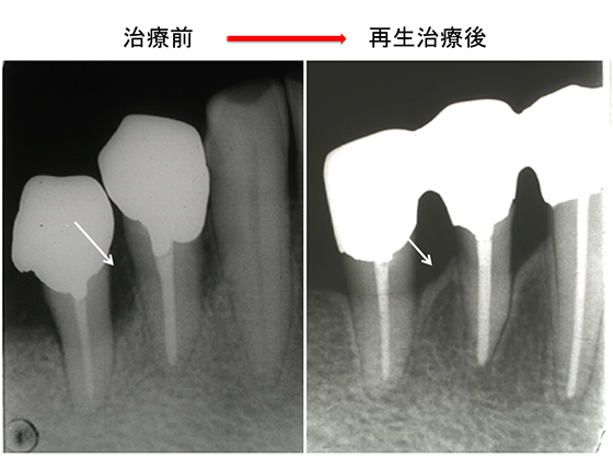 骨再生治療前と治療後