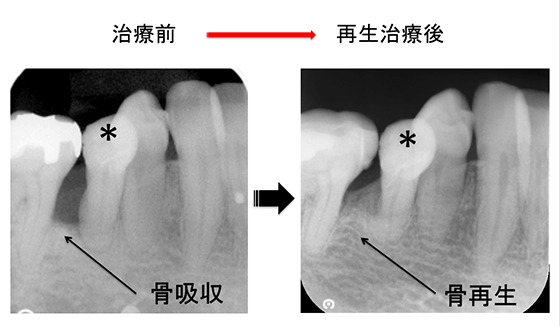 骨再生治療前と治療後