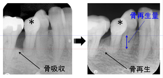 治療前と治療後の骨再生量