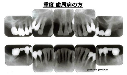 重度歯周病の方の写真