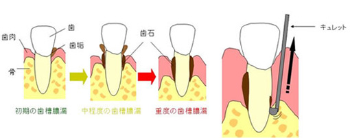 ルートプレーニング（歯周病細菌除去療法）