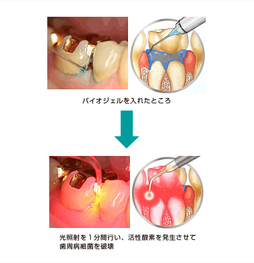 PDT（a- PDT）：最新の歯周病治療