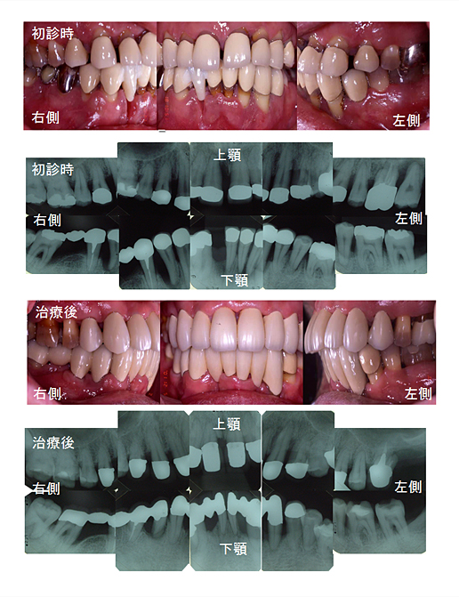症例報告 初診時 40歳 侵襲性歯周炎