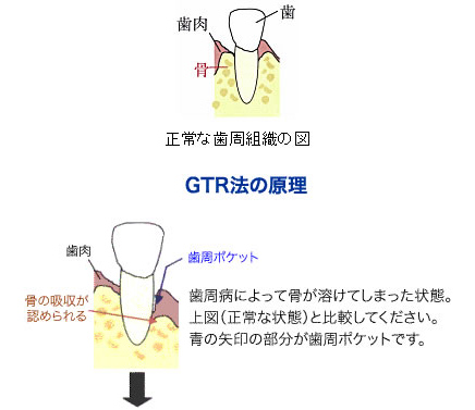 gtr法の原理