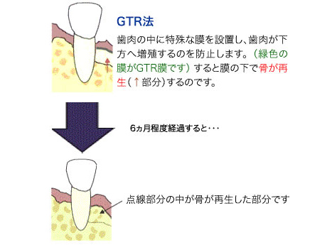 gtr法の原理