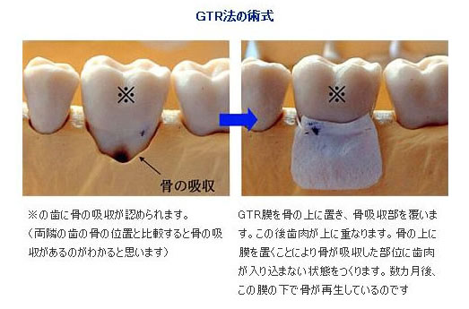 gtr法の術式