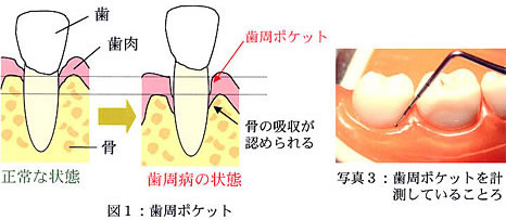 歯周ポケット