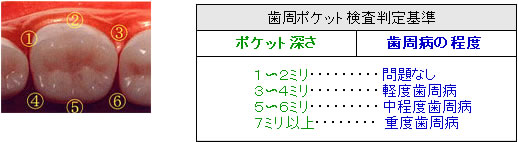 歯周ポケット検査判定基準