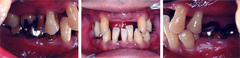 歯周病細菌検査