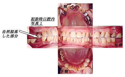 初診時口腔内写真1