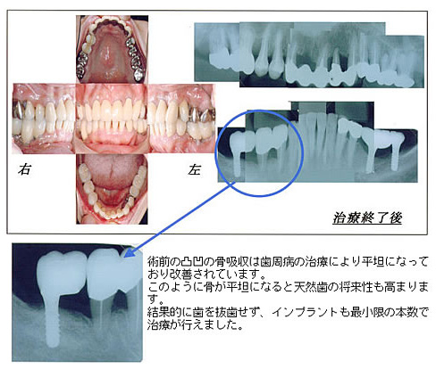 治療終了時写真