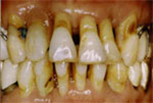 歯周病の人の口腔内