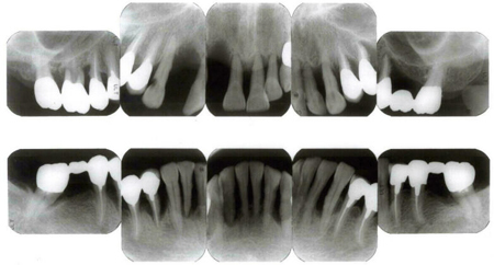 歯周病の人のレントゲン