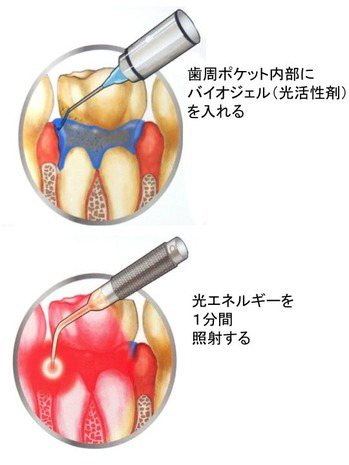 PDTの実際の使用方法