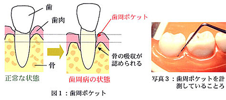 歯周ポケットを計測