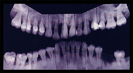 歯周病のレントゲン写真