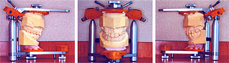 噛み合せの検査のため咬合器に歯型を取り付けたところ