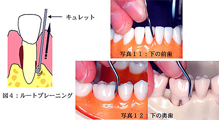 ルートプレーニングの方法を図式化