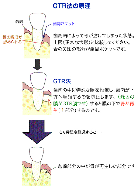 GTR法の原理