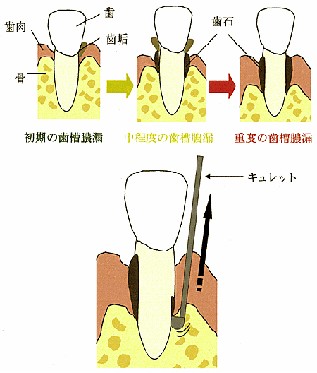 ルートプレーニング