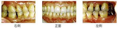 治療終了後口腔内写真